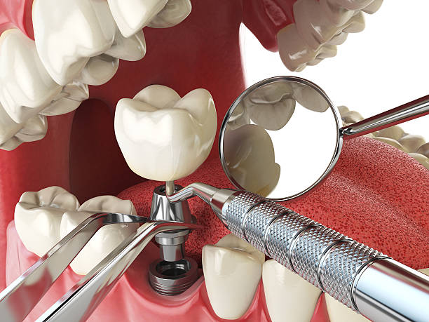 Best Emergency Broken Tooth Repair in Galesburg, MI