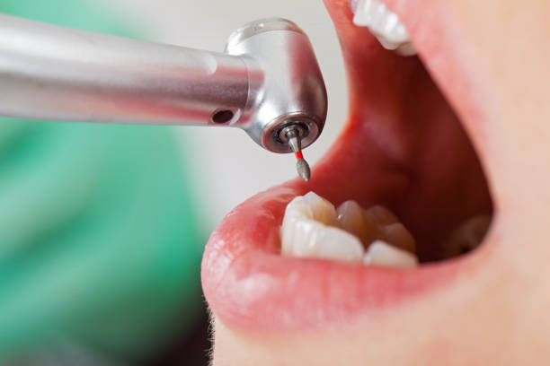 Best Emergency Wisdom Teeth Removal in Galesburg, MI